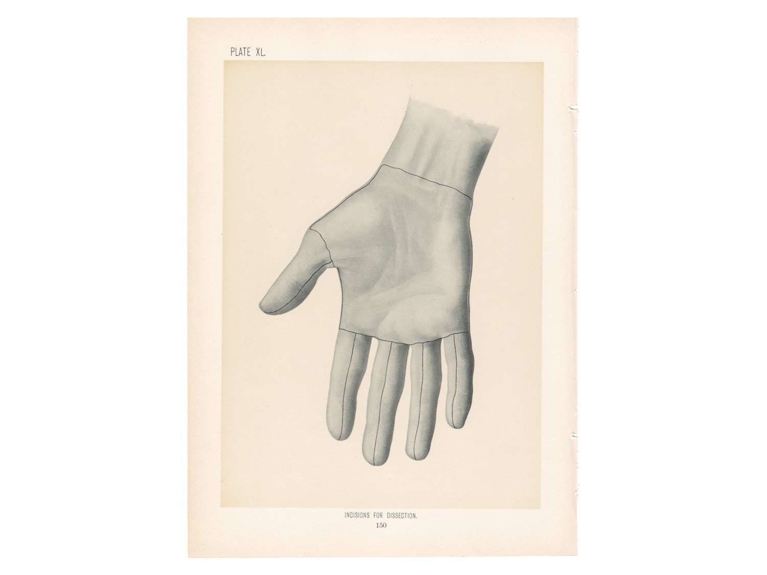 Antique Human HAND with Incisions for Dissection Surgical Anatomy Illustration