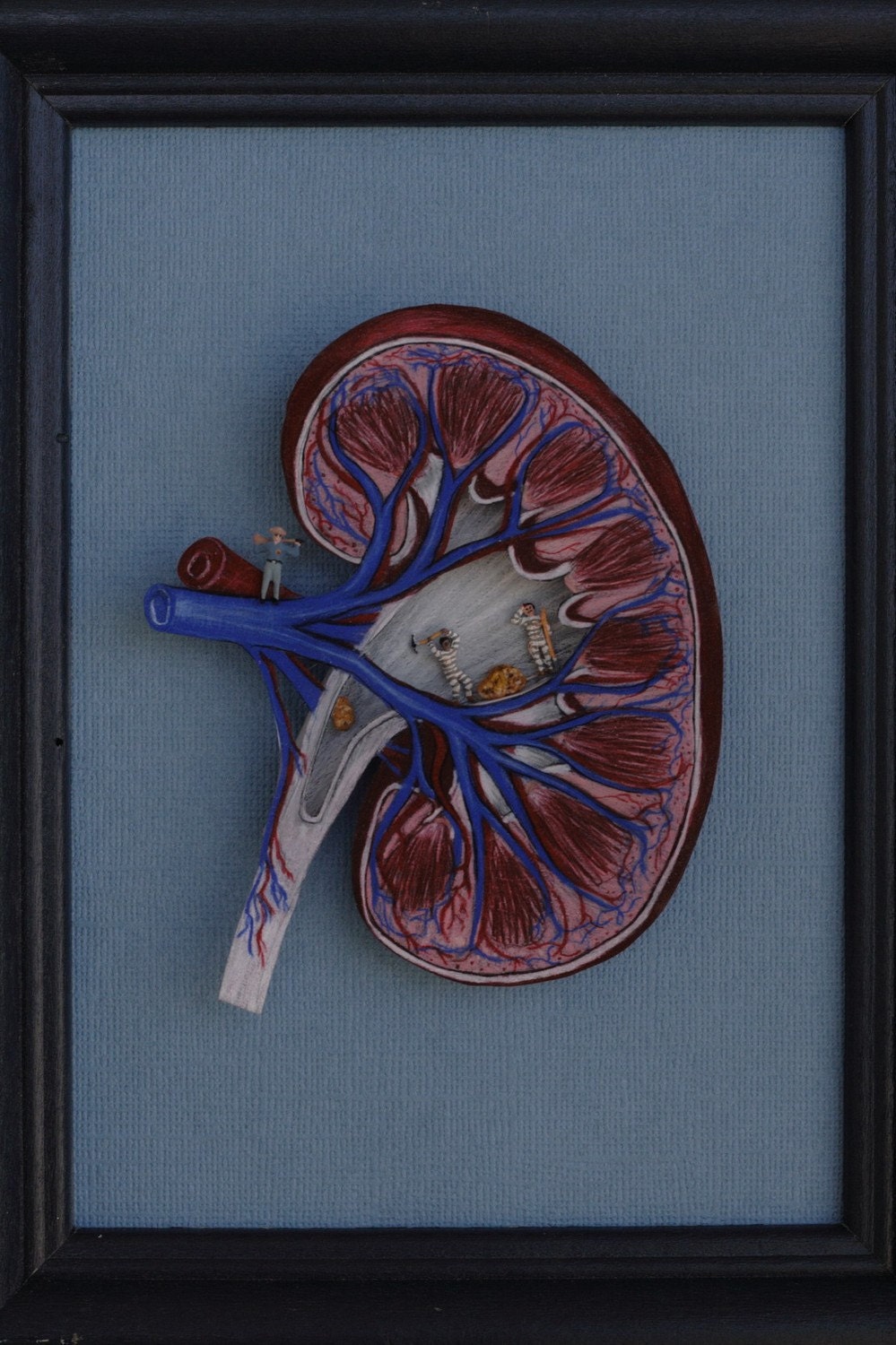 kidney Stones